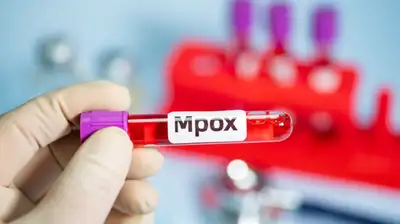 notícia: Mpox: Governo do Estado esclarece que não há casos suspeitos, prováveis ou confirmados no Amapá em 2025