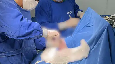 notícia: Hospital da Criança e do Adolescente realiza 1ª cirurgia de trepanação craniana bilateral após inauguração do novo centro cirúrgico 