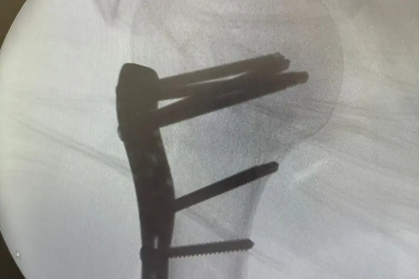 Registro do resultado após cirurgias ortopédica